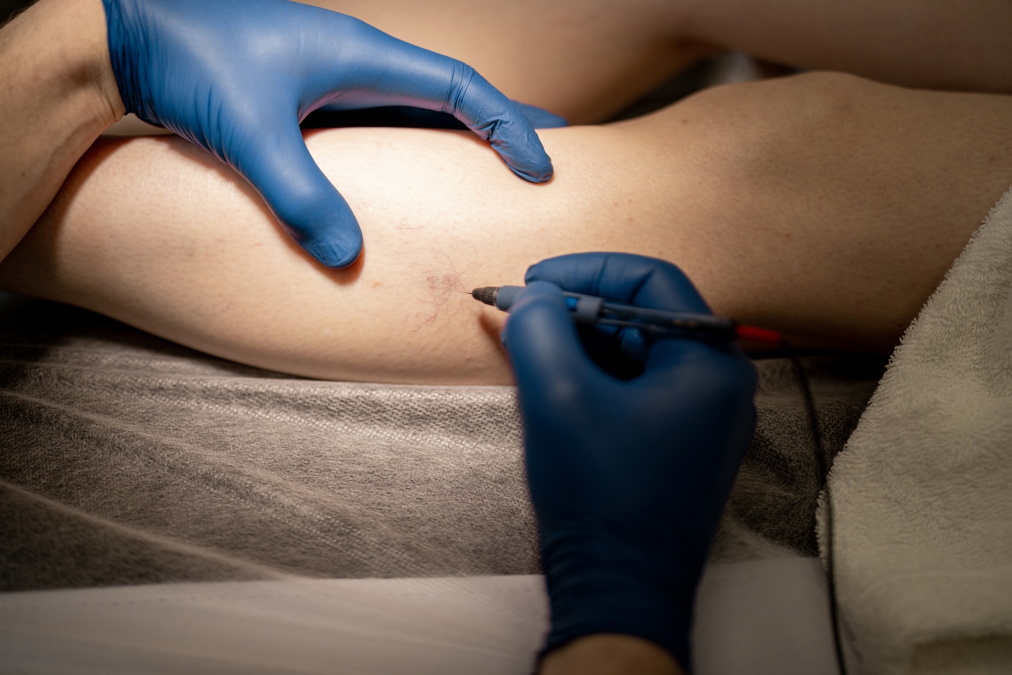 Debunking Top 5 Vein Therapy Myths at Temecula Body Contouring