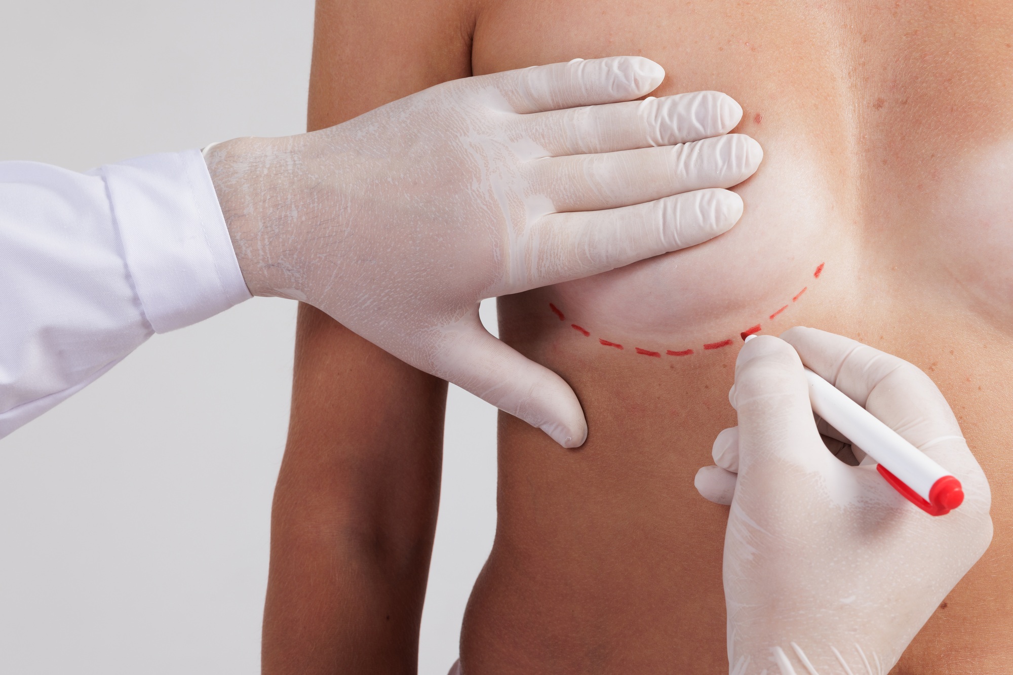 Breast Augmentation: Empower Your Life with Temecula Body Contouring