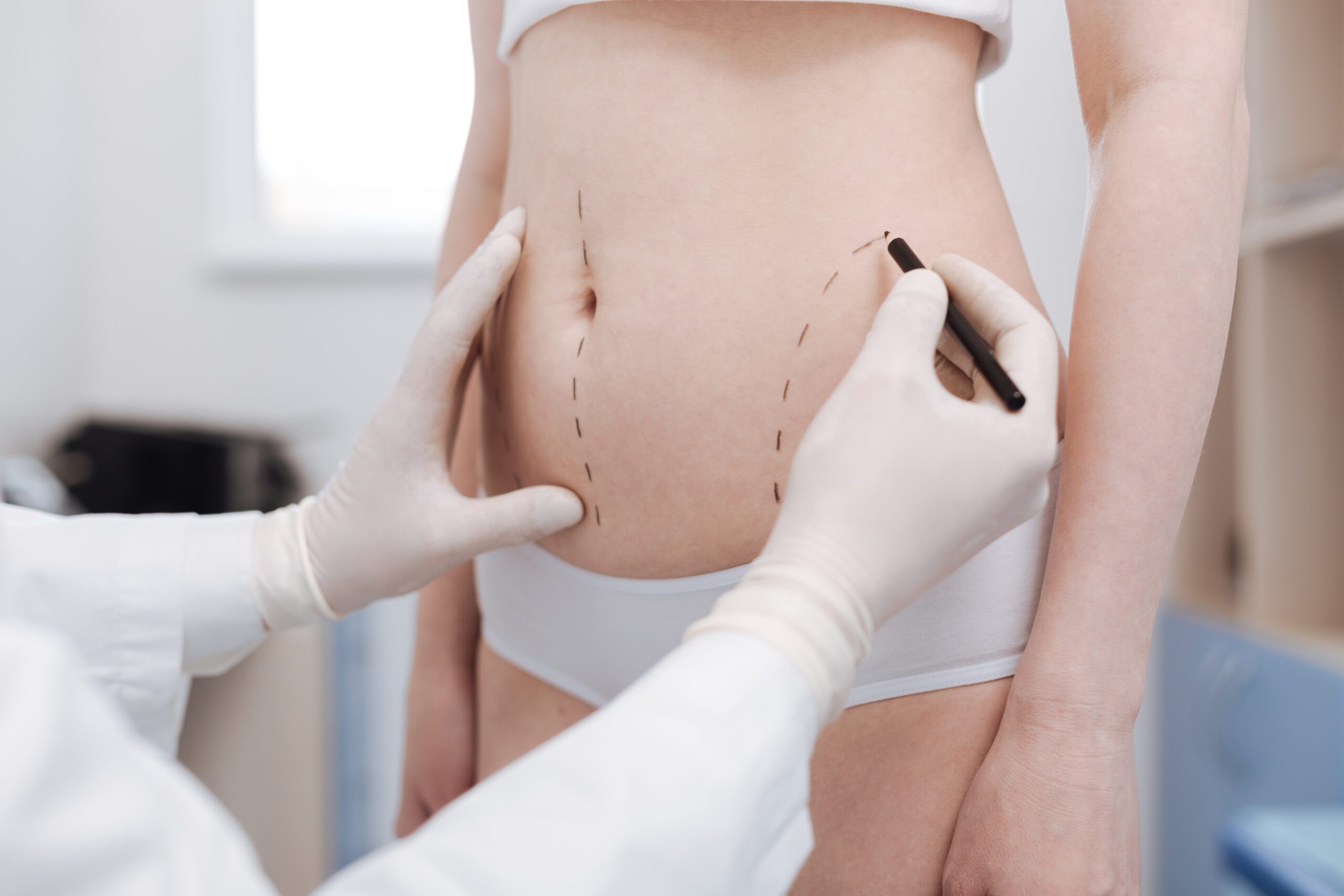 Temecula Body Contouring Insights: Your Guide to Liposuction and Wellness Confidence