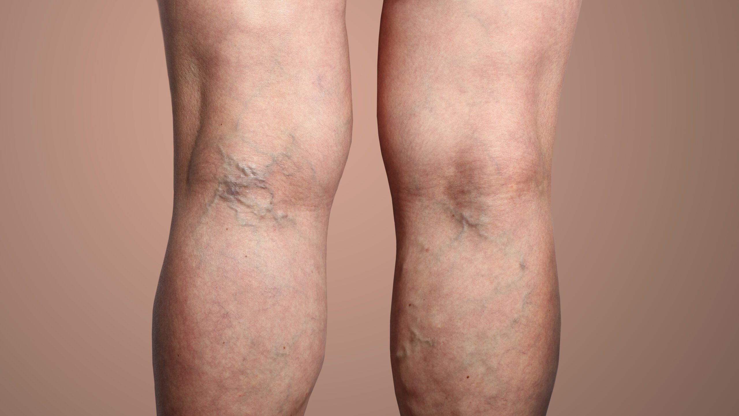 Temecula Body Contouring Insights: Expert Vein Therapy FAQ and Confidence-Boosting Transformations